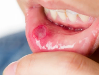 Ο «ύπουλος» καρκίνος του στόματος: Συμπτώματα και πρόληψη